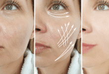 Face Wrinkles Treatment