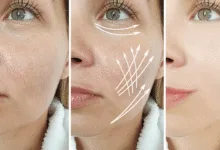 Face Wrinkles Treatment