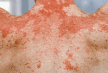 தோல் நோய்க்கு சாப்பிட வேண்டிய உணவுகள்