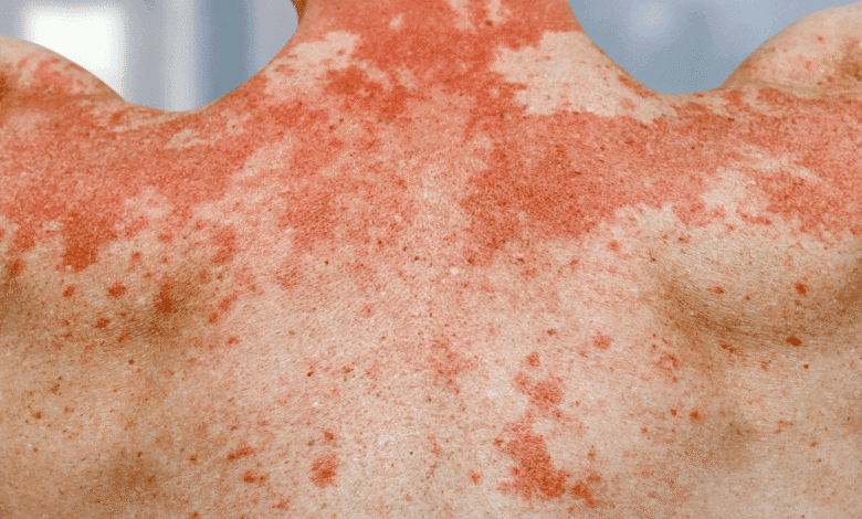 தோல் நோய்க்கு சாப்பிட வேண்டிய உணவுகள்